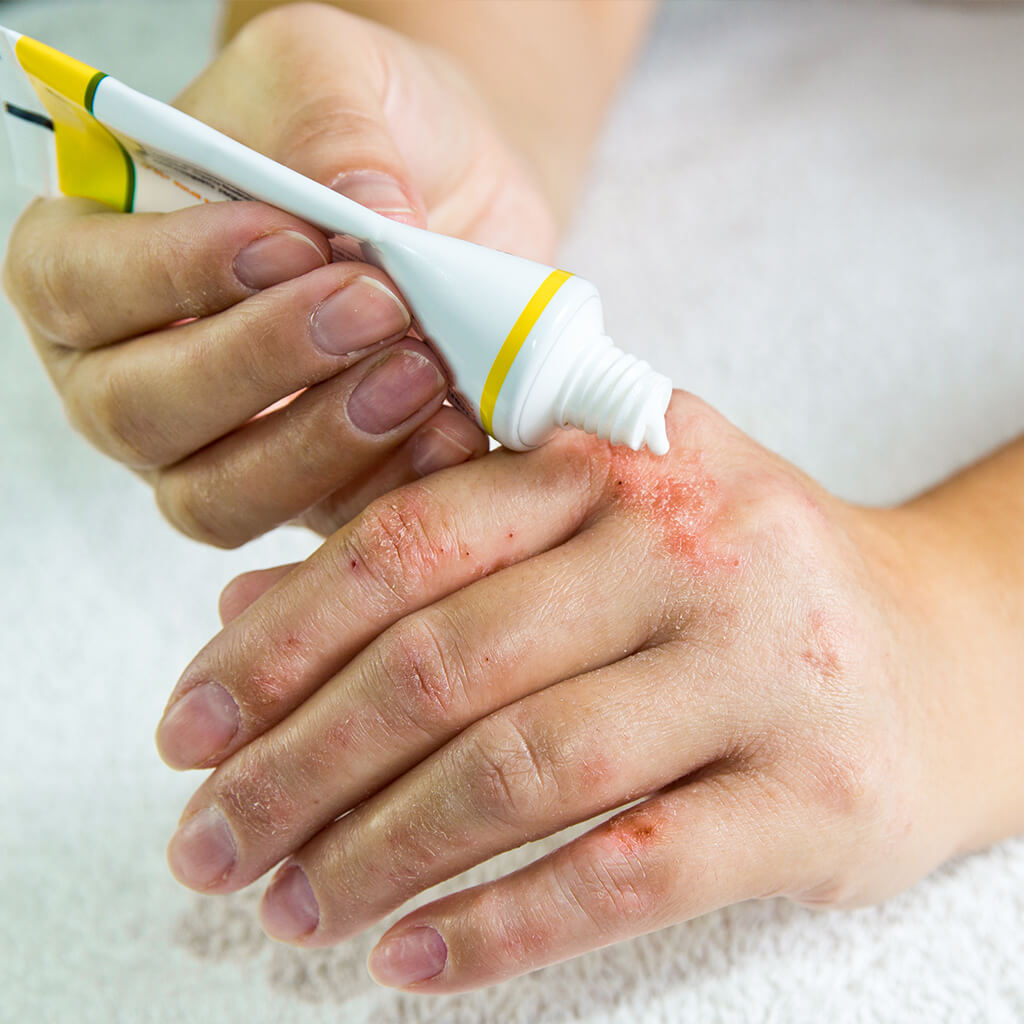 Psoriazisul: ce este și cum se tratează