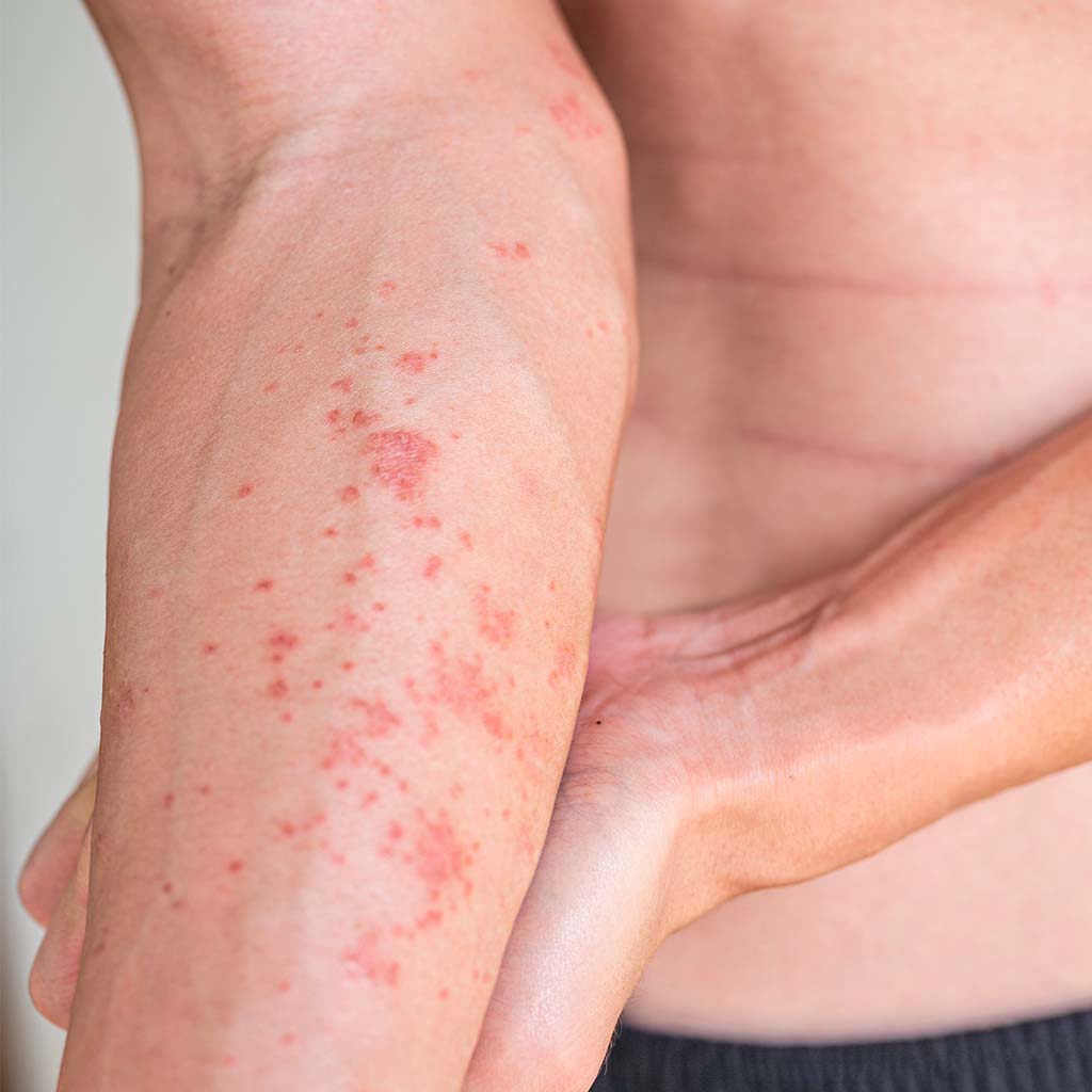 Eczema: how to recognize and treat it