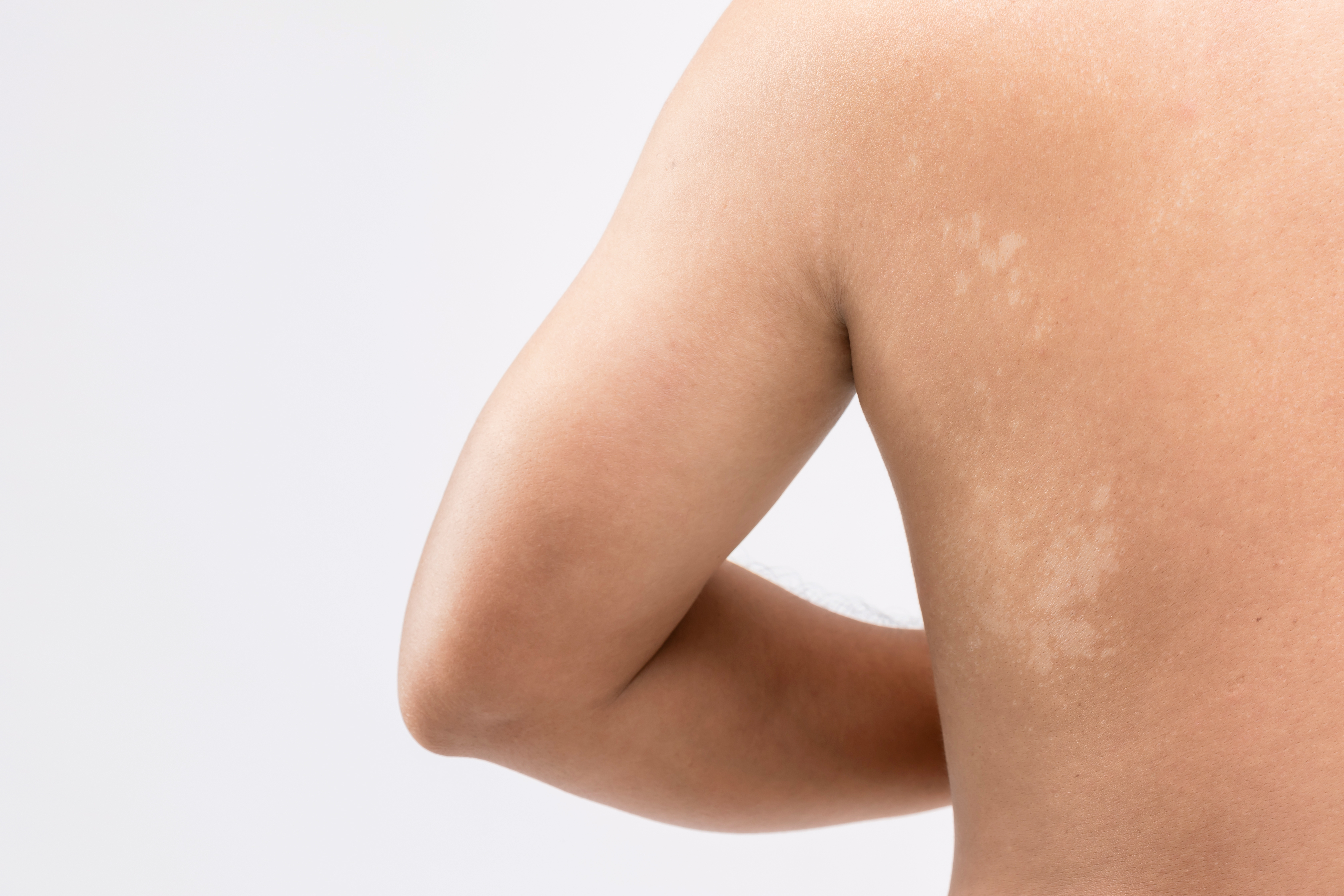 What does cause white spots on the skin?