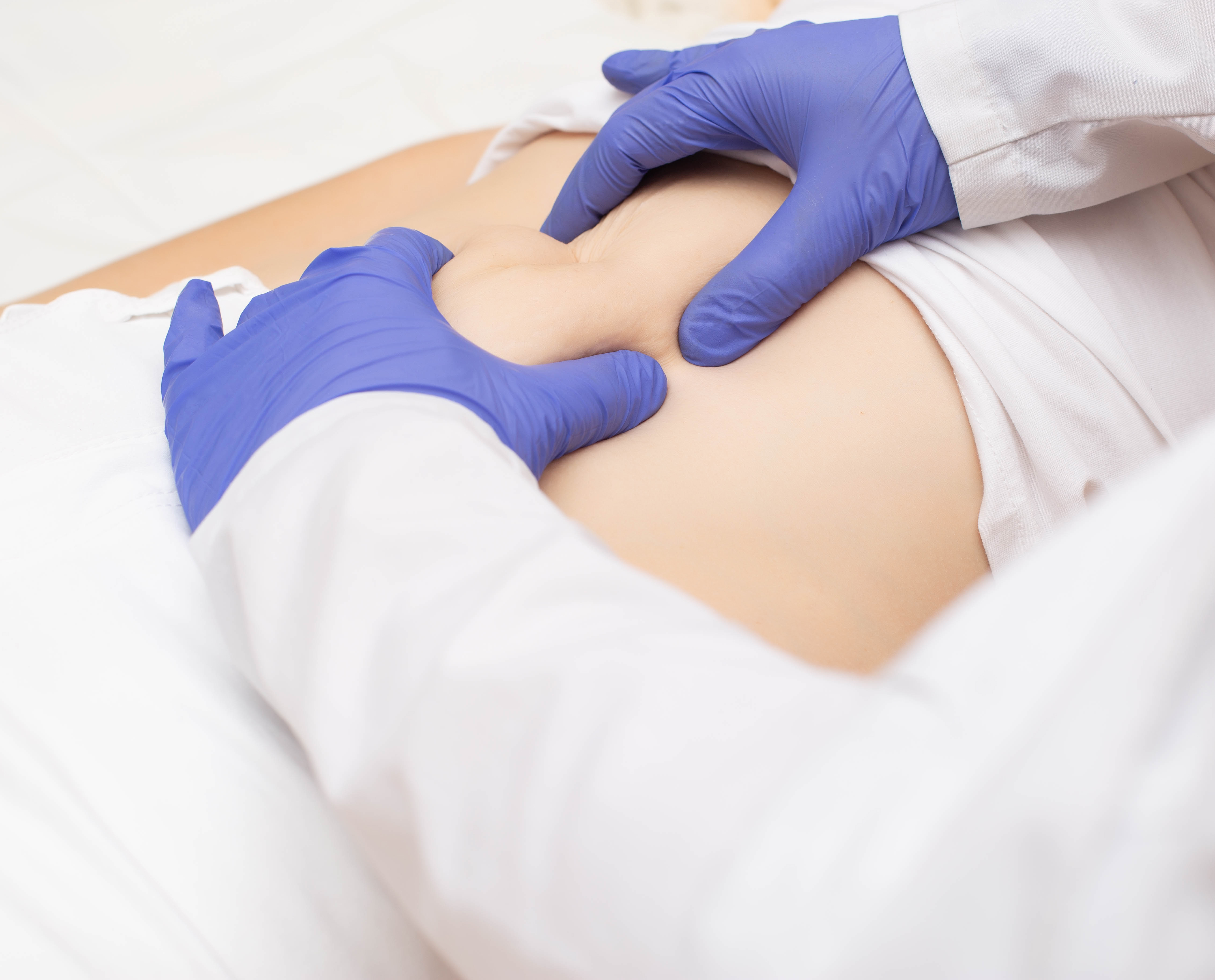 Abdominal Wall Hernia: What Is It and How to Treat It