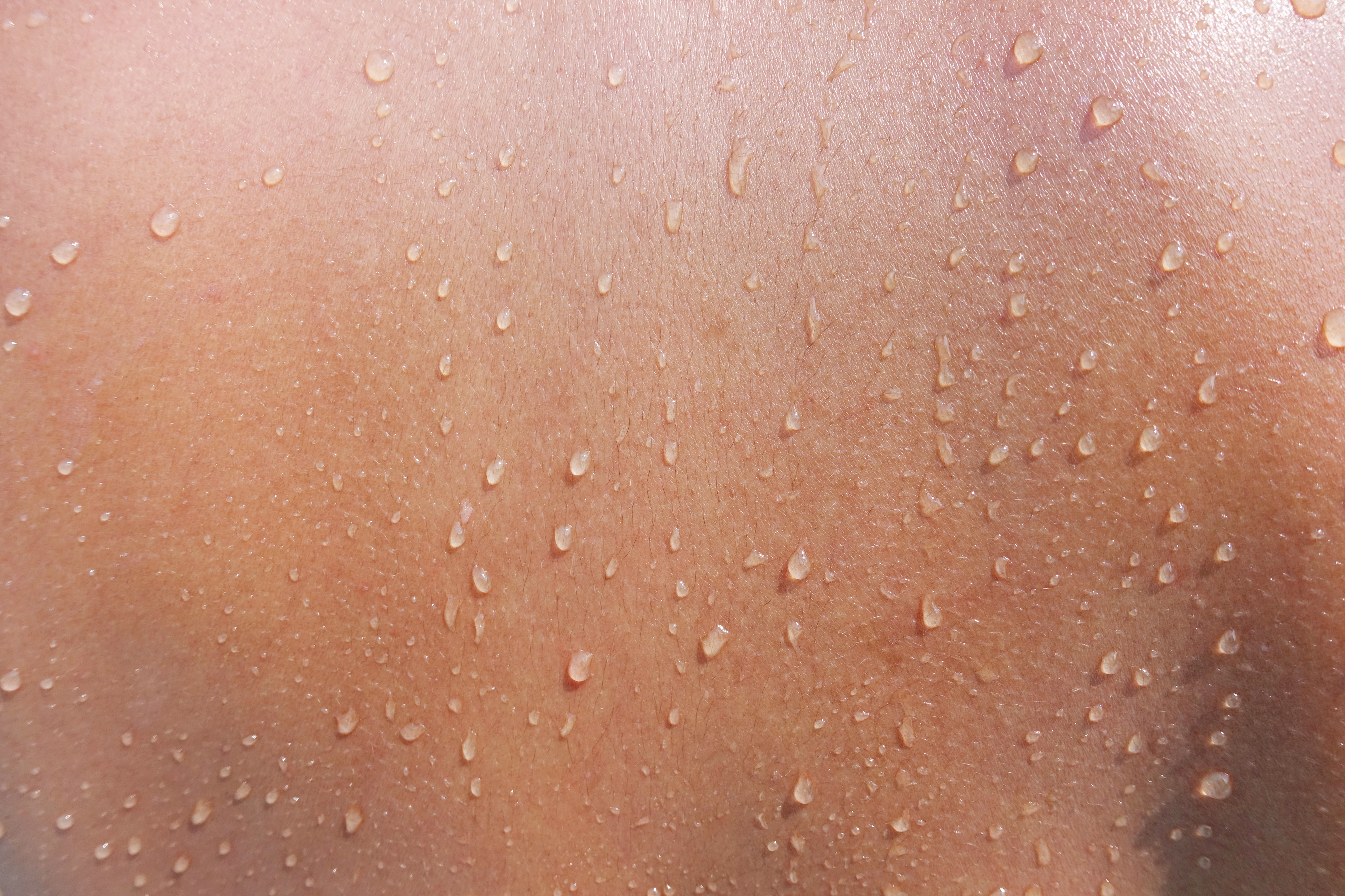 Hyperhidrosis in summer: what are the most innovative treatments