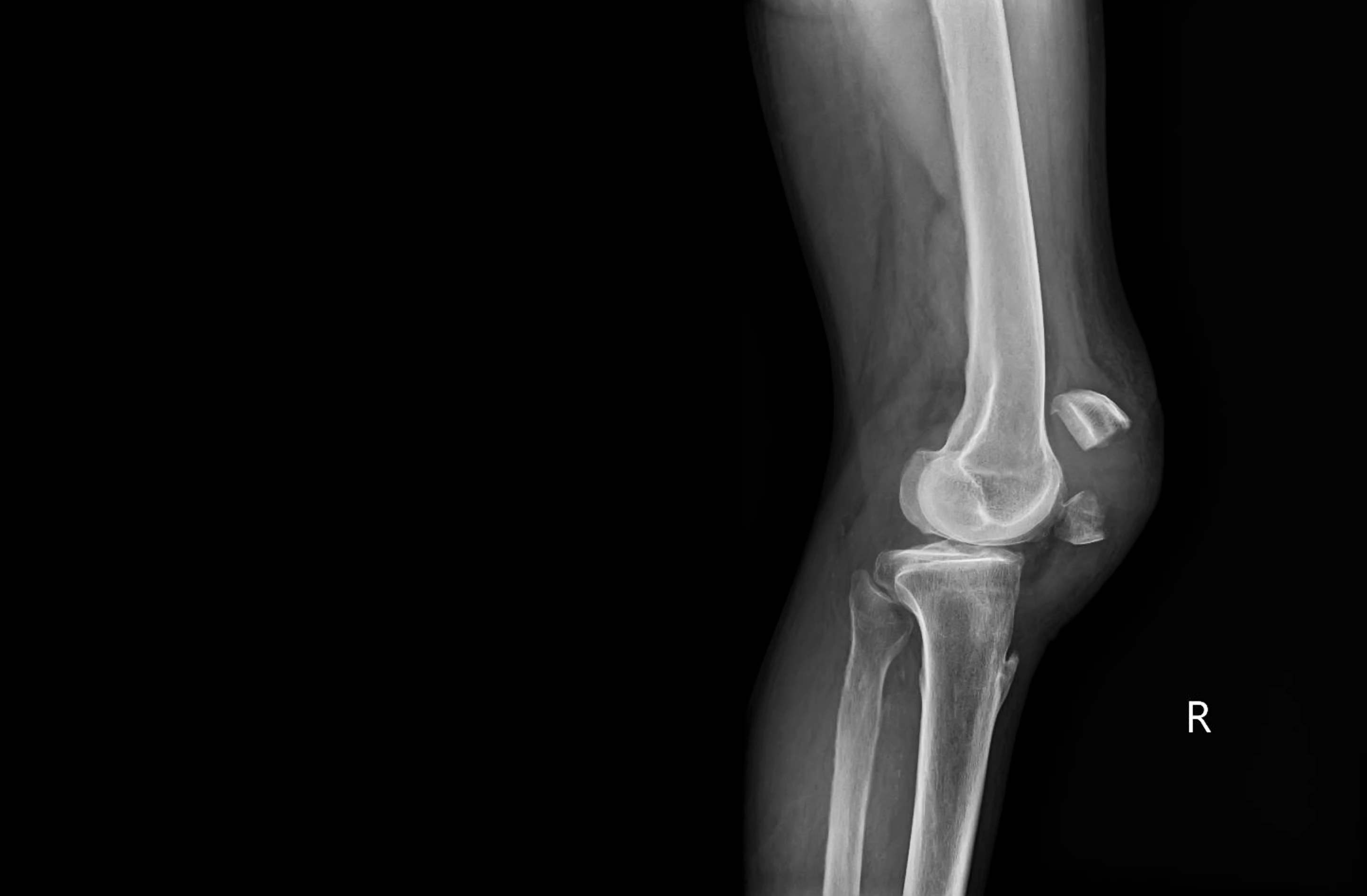 Robotic orthopedics in knee prostheses: how it works and what it is used for