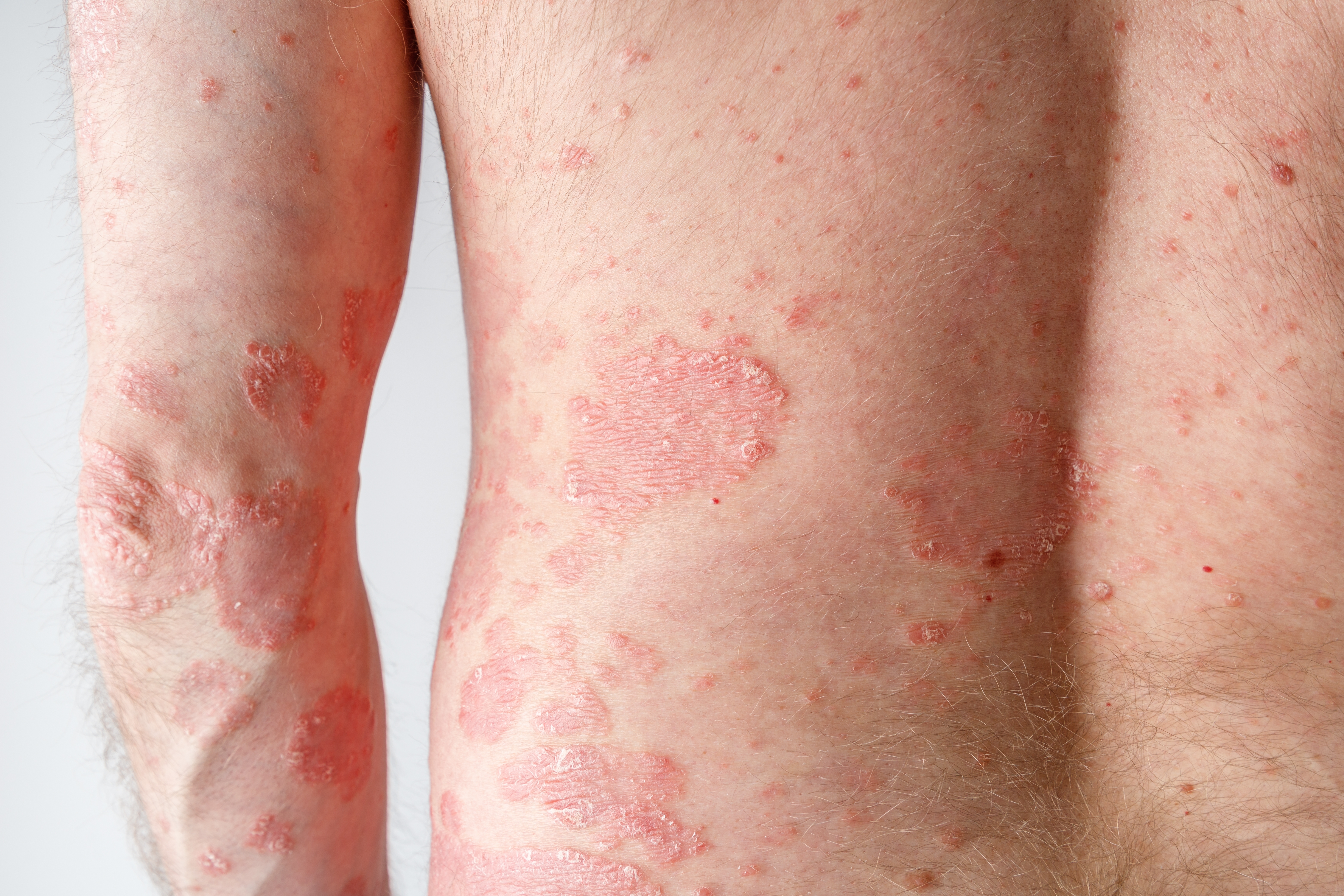 Gibert’s pityriasis rosea: What it Is and How to Treat It