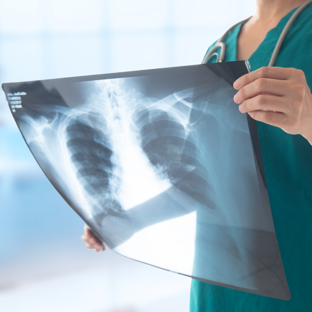 Emfizemul pulmonar: ce este, tratamentul și rolul fumatului